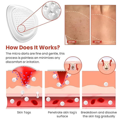 Skin Tag Remover Patch (72 Patches)